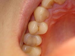 Кариес на контактных поверхностях зуба. наиболее сложно поддается диагностике